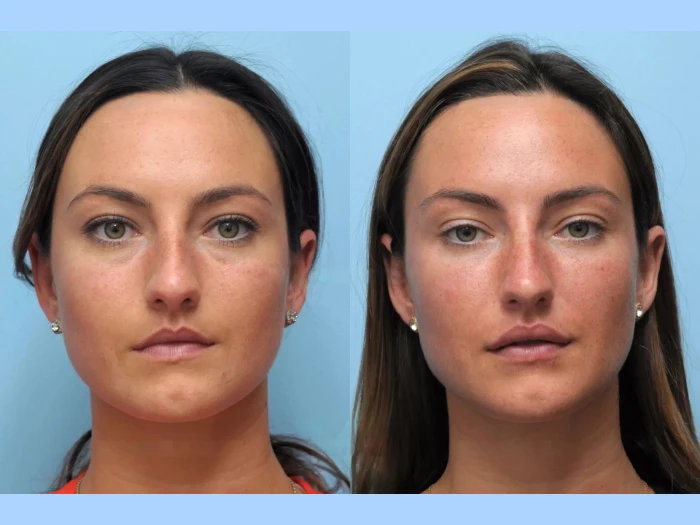 Rediscover Facial Definition with Thread Lift Treatment in Dubai