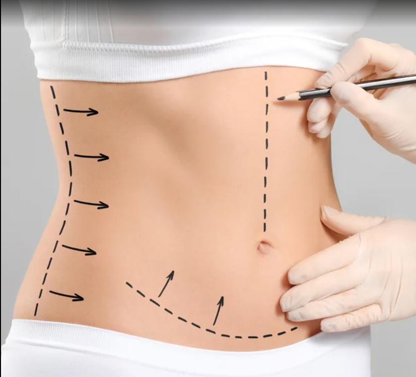 Tummy Tuck In Dubai
