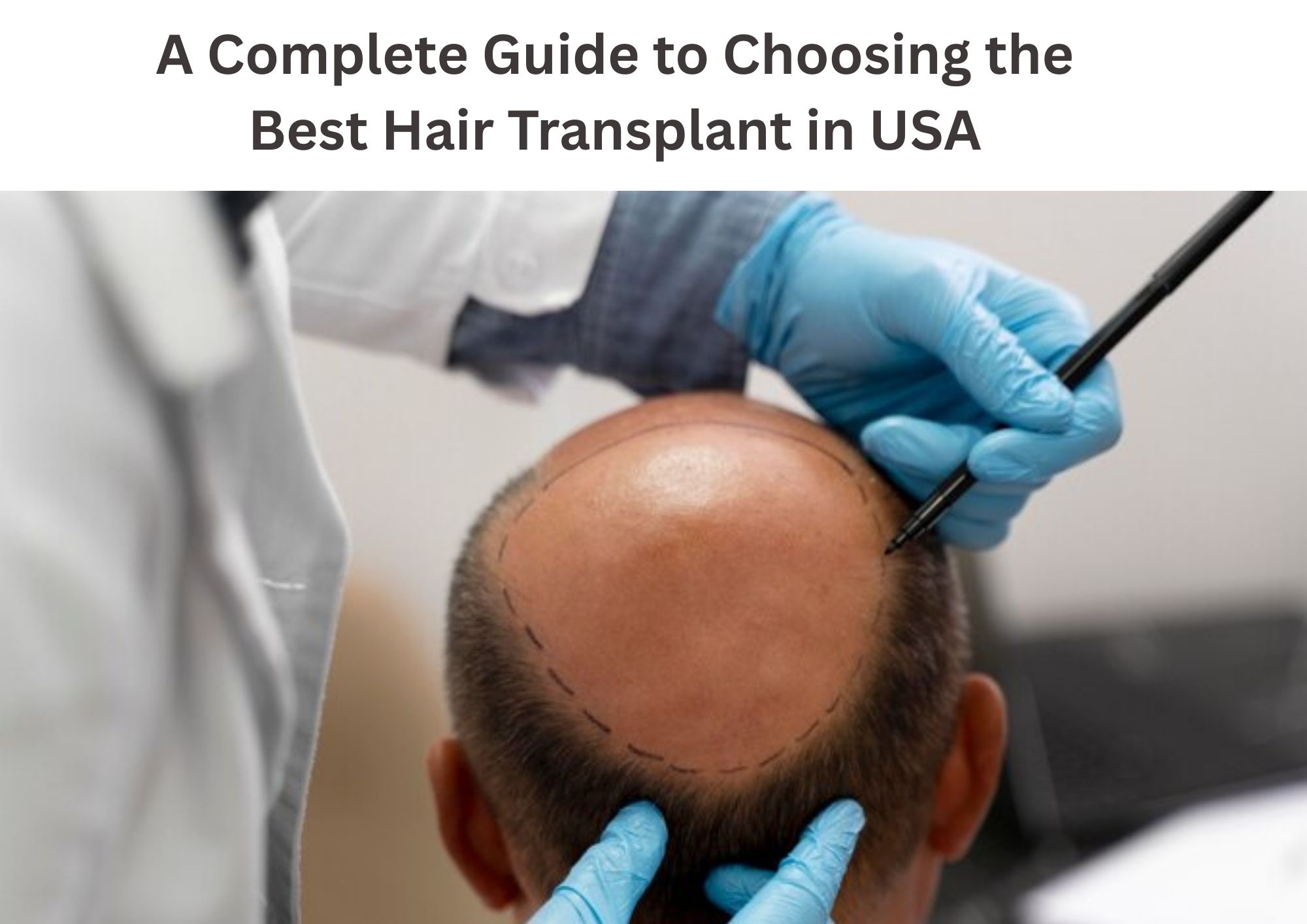 A Complete Guide to Choosing the Best Hair Transplant in USA