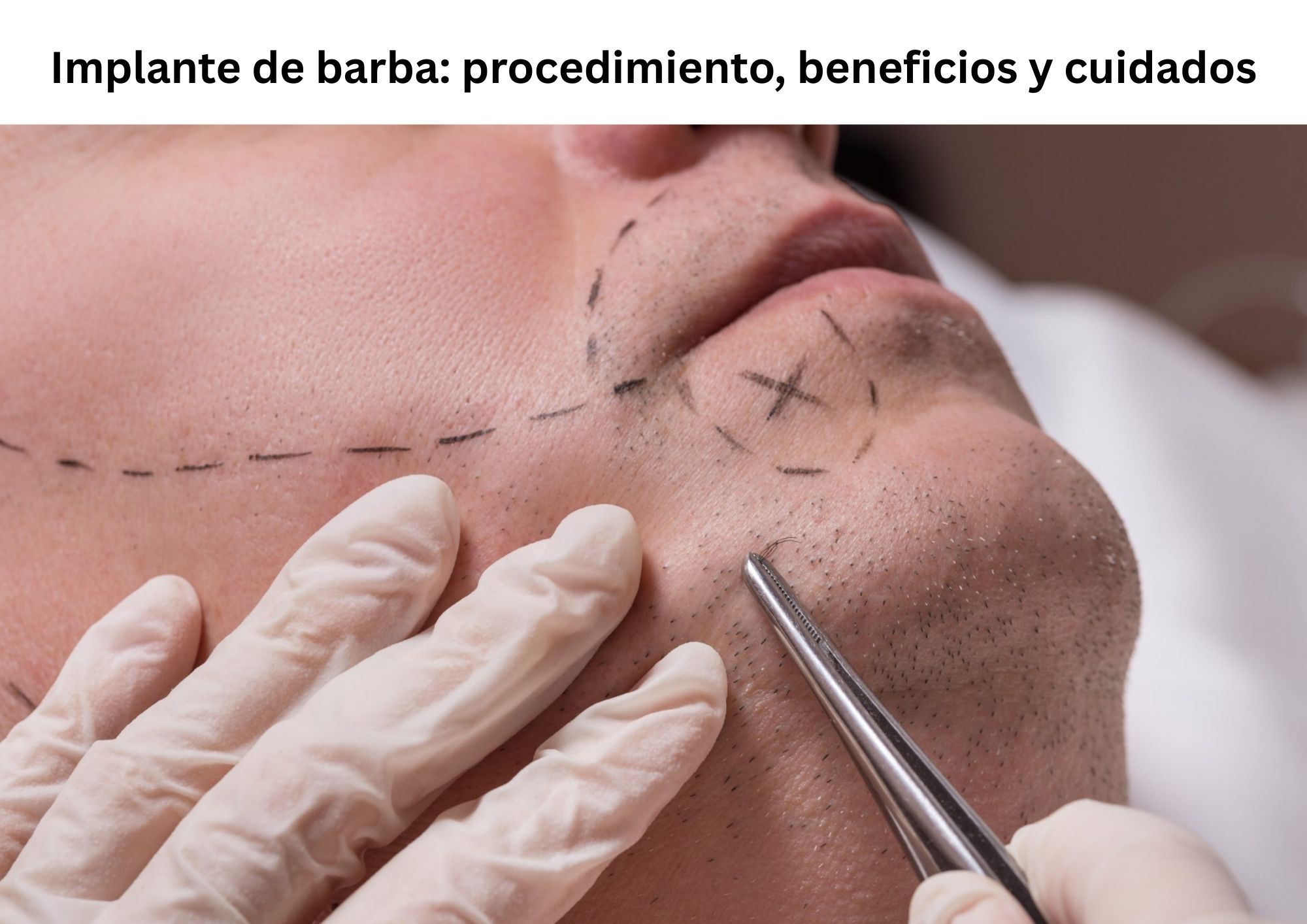 Implante de barba: procedimiento, beneficios y cuidados