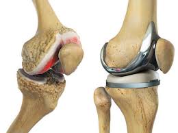 Knee replacement surgery