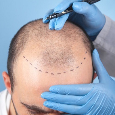 Are There Any Risks Associated with FUE Hair Transplant?