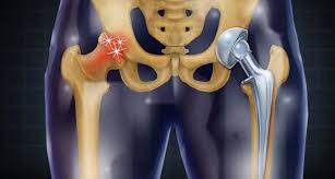 hip replacement surgery