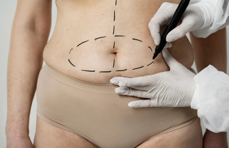 Liposuction Surgery