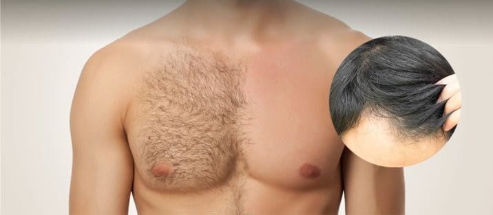 Body Hair Transplant