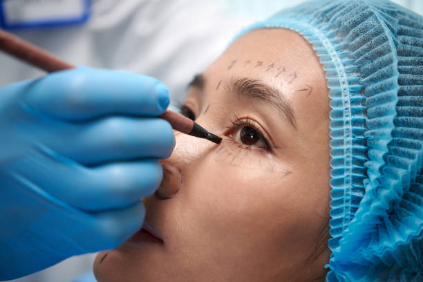 Upper eyelid surgery