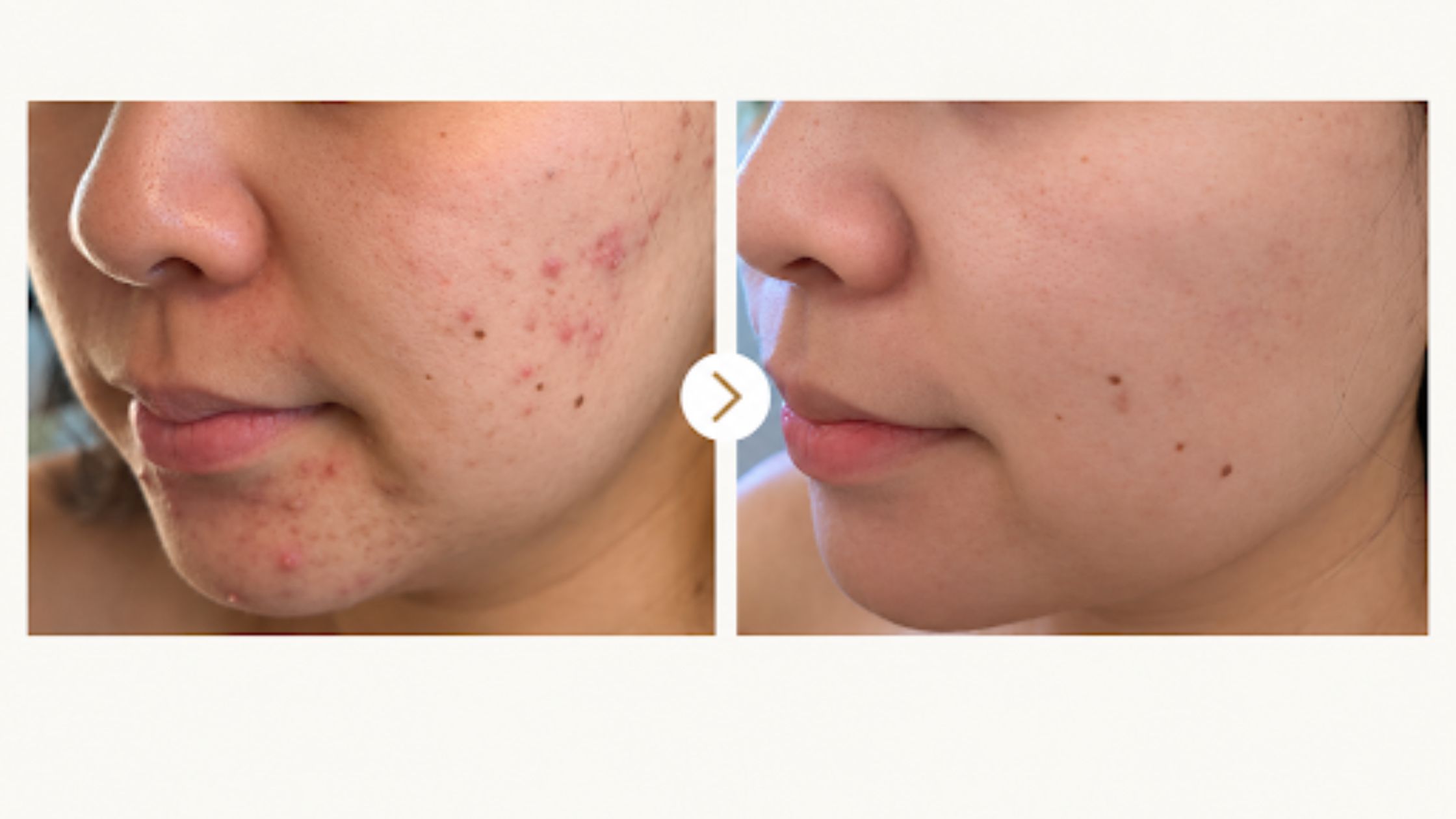 Melasma Laser Treatment